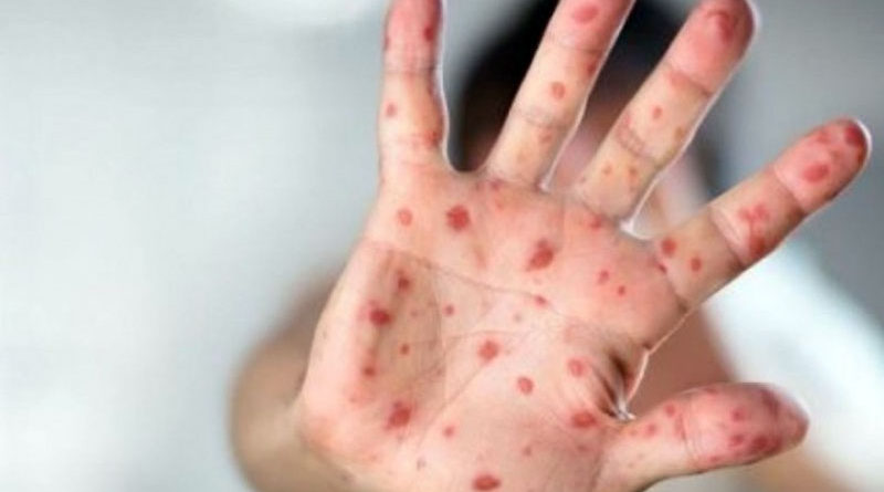 INFORME EPIDEMIOLÓGICO: Nuevos casos de Sarampión y Dengue en la provincia de Buenos Aires