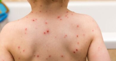 Varicela: Segunda dosis de la vacuna al calendario nacional